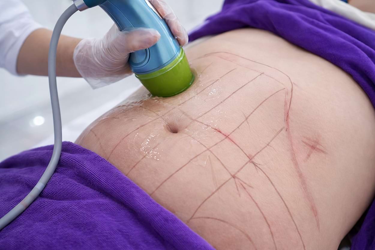 Estetický prístroj BeautyRelax Bodyshape HIFU Tripple Attack Studio