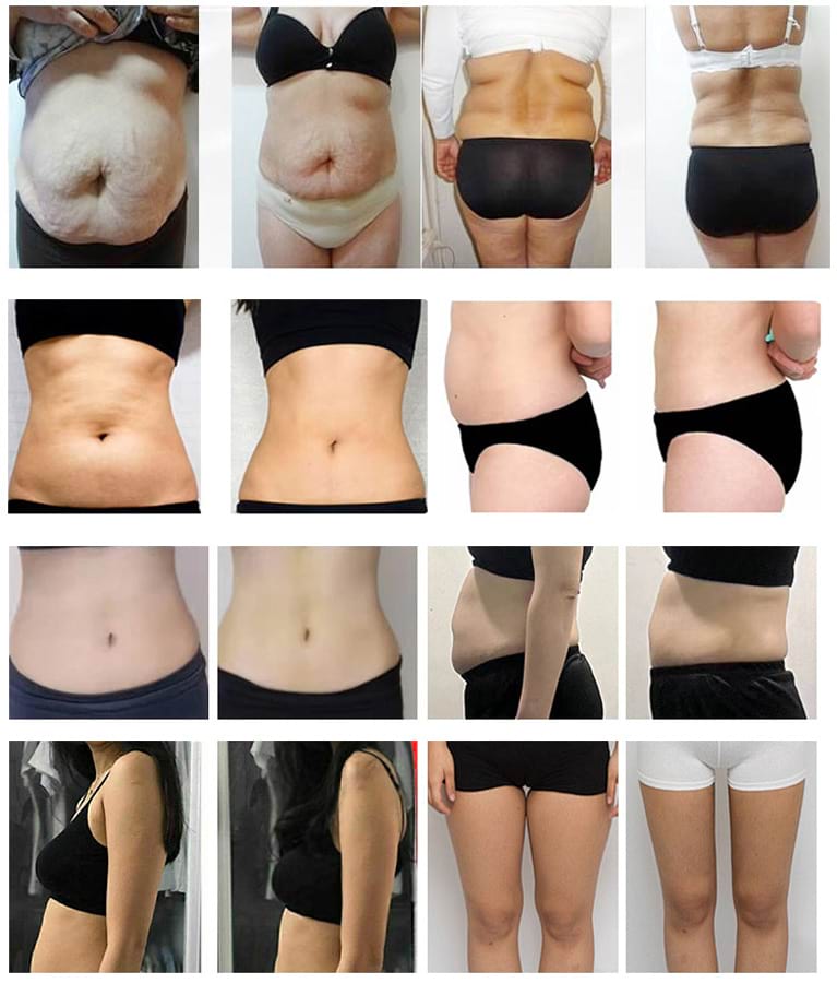 Estetický prístroj na formovanie postavy BeautyRelax Lipolaser Professional Studio EMS