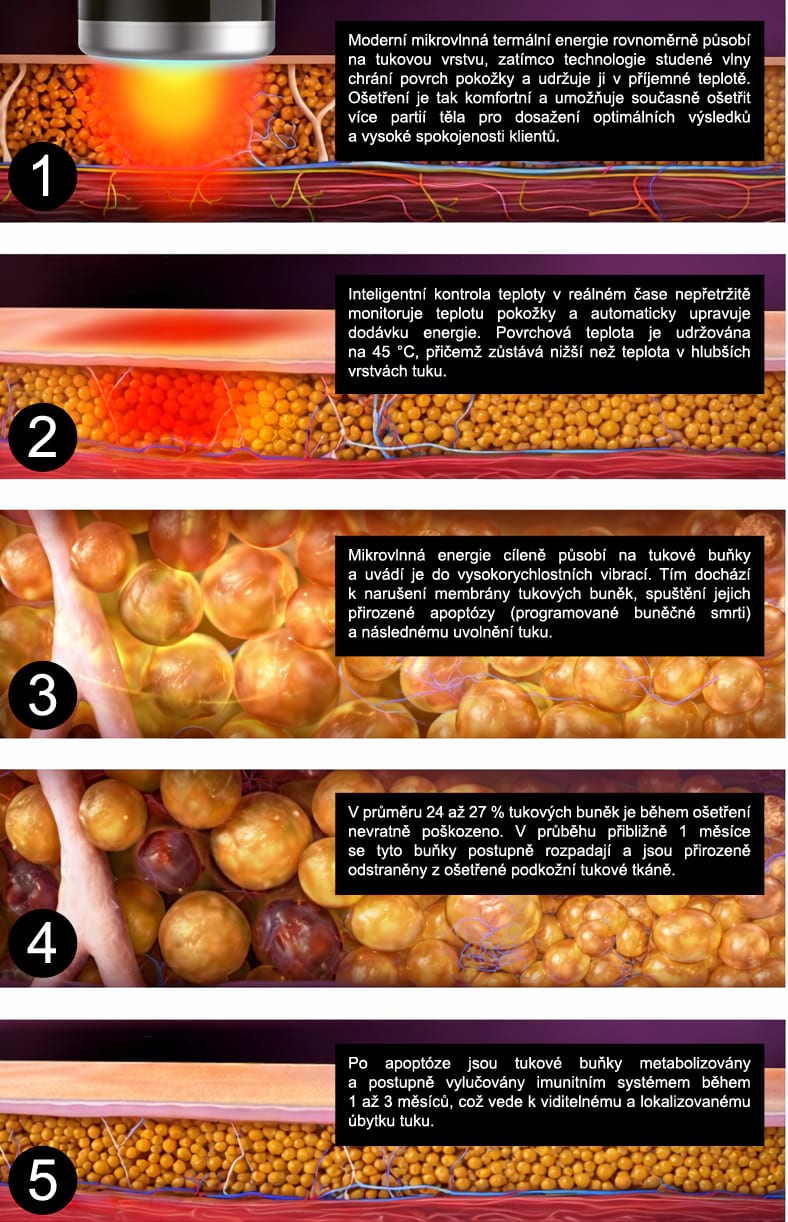 Estetický prístroj na formovanie postavy BeautyRelax ThermalWave Slim Professional Studio – Obrázok 14