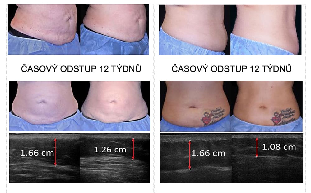 Estetický prístroj na formovanie postavy BeautyRelax ThermalWave Slim Professional Studio – Obrázok 16