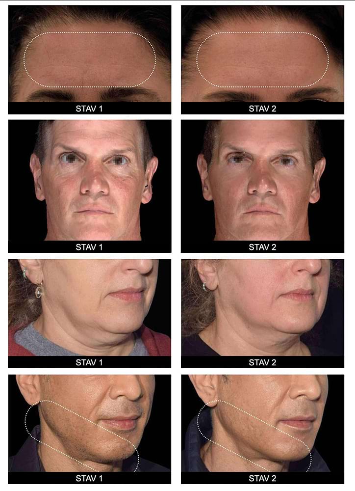 Estetický prístroj na lifting pleti BeautyRelax Magnetic Pulsemax Face Twin