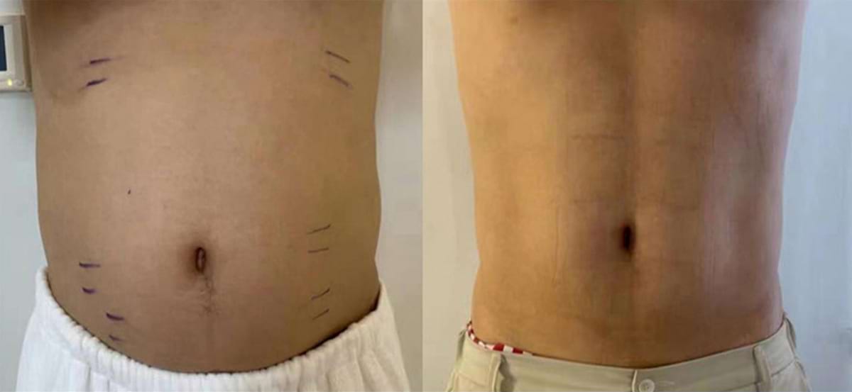 Masážny prístroj na formovanie postavy BeautyRelax Magnetic Pulsemax Studio Performance – Obrázok 29