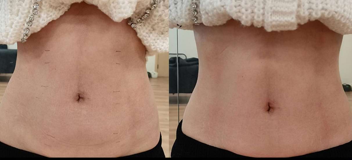 Masážny prístroj na formovanie postavy BeautyRelax Magnetic Pulsemax Studio Performance – Obrázok 28