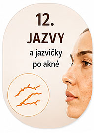 Jazvy a jazvičky po akné