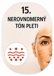 Nerovnomerný tón pleti